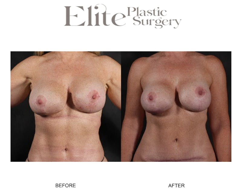 Breast Augmentation Before & After Gallery - Patient 148161 - Image 1