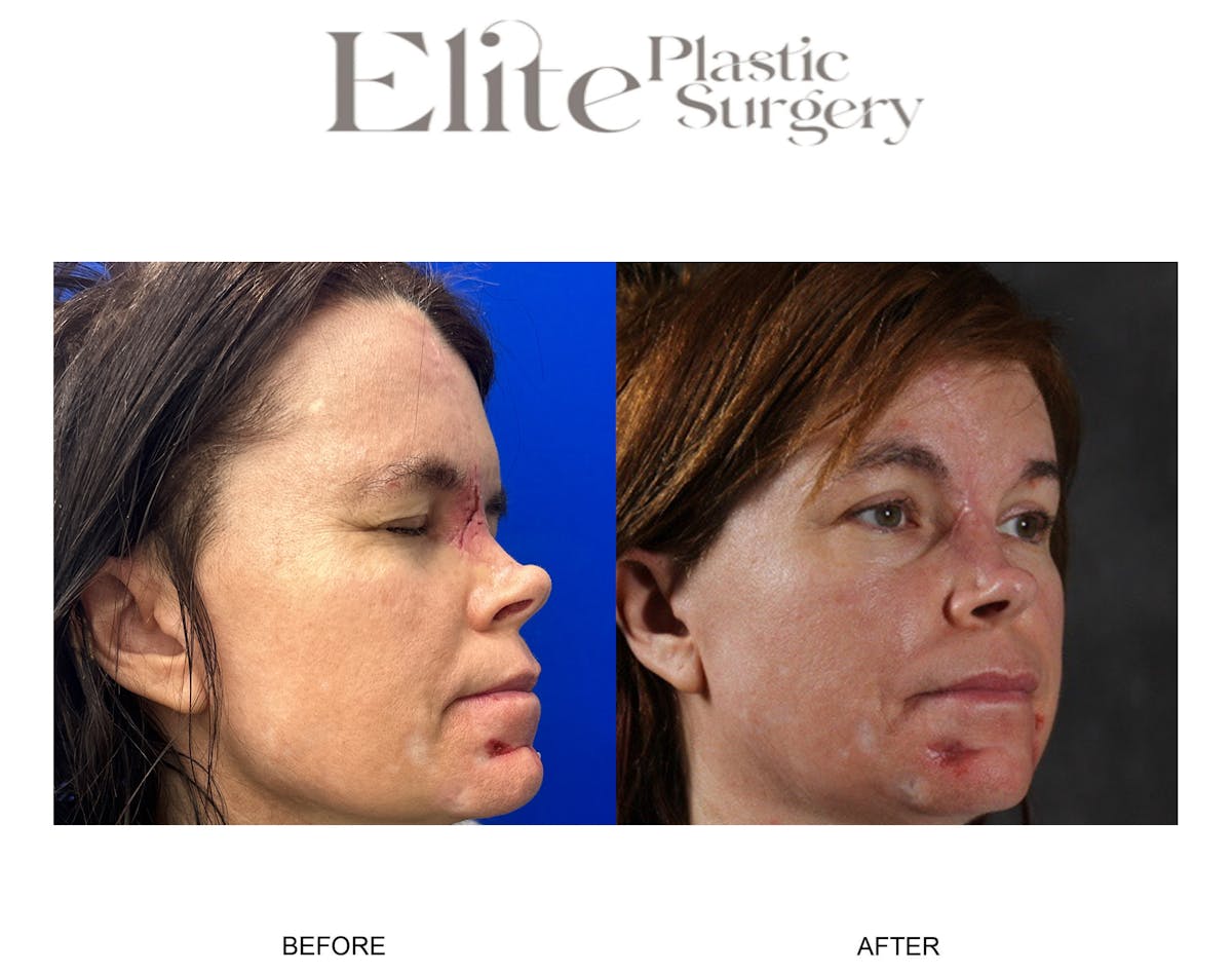 Facial Reconstruction Before & After Gallery - Patient 291811 - Image 3