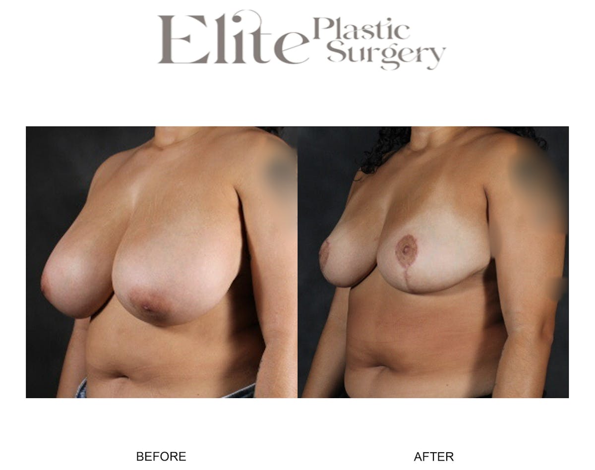 Breast Reduction Before & After Gallery - Patient 283309 - Image 2