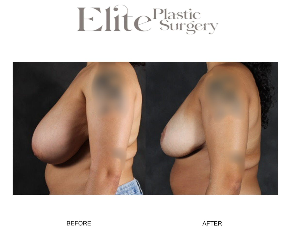 Breast Reduction Before & After Gallery - Patient 283309 - Image 3