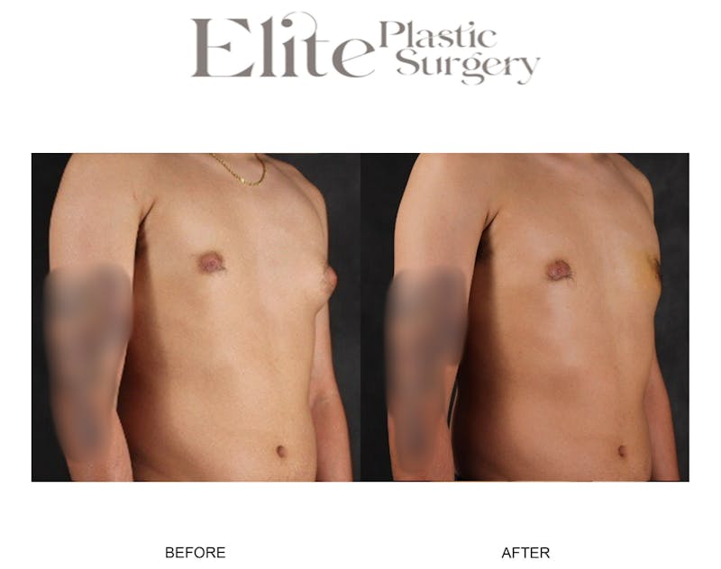Male Gynecomastia Before & After Gallery - Patient 140838 - Image 1