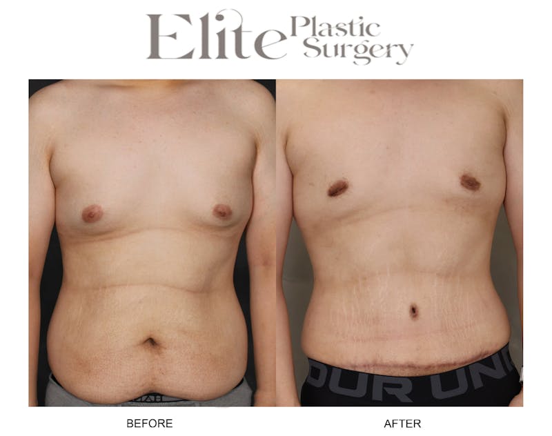 Male Gynecomastia Before & After Gallery - Patient 188018 - Image 1