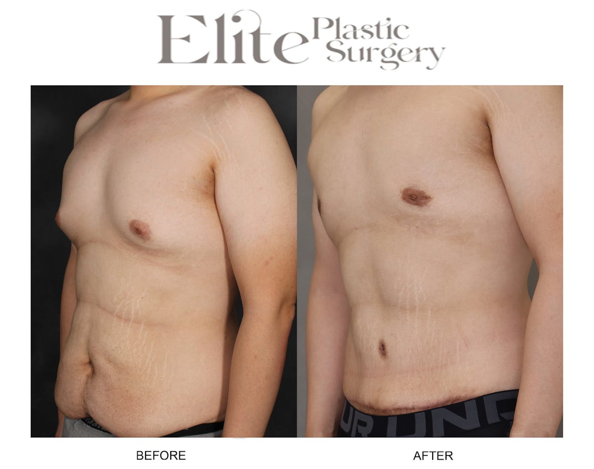Male Gynecomastia Before & After Gallery - Patient 188018 - Image 2