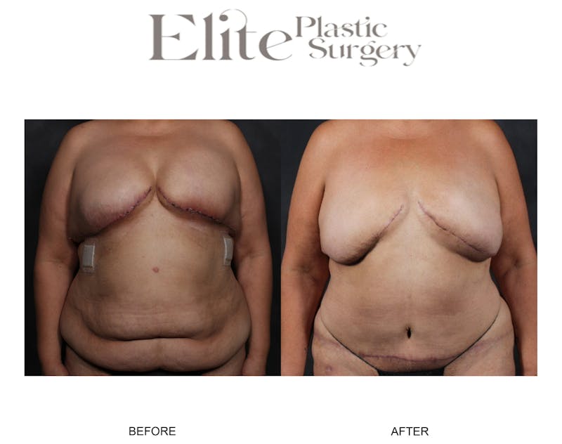 DIEP Breast Reconstruction Before & After Gallery - Patient 348134 - Image 1