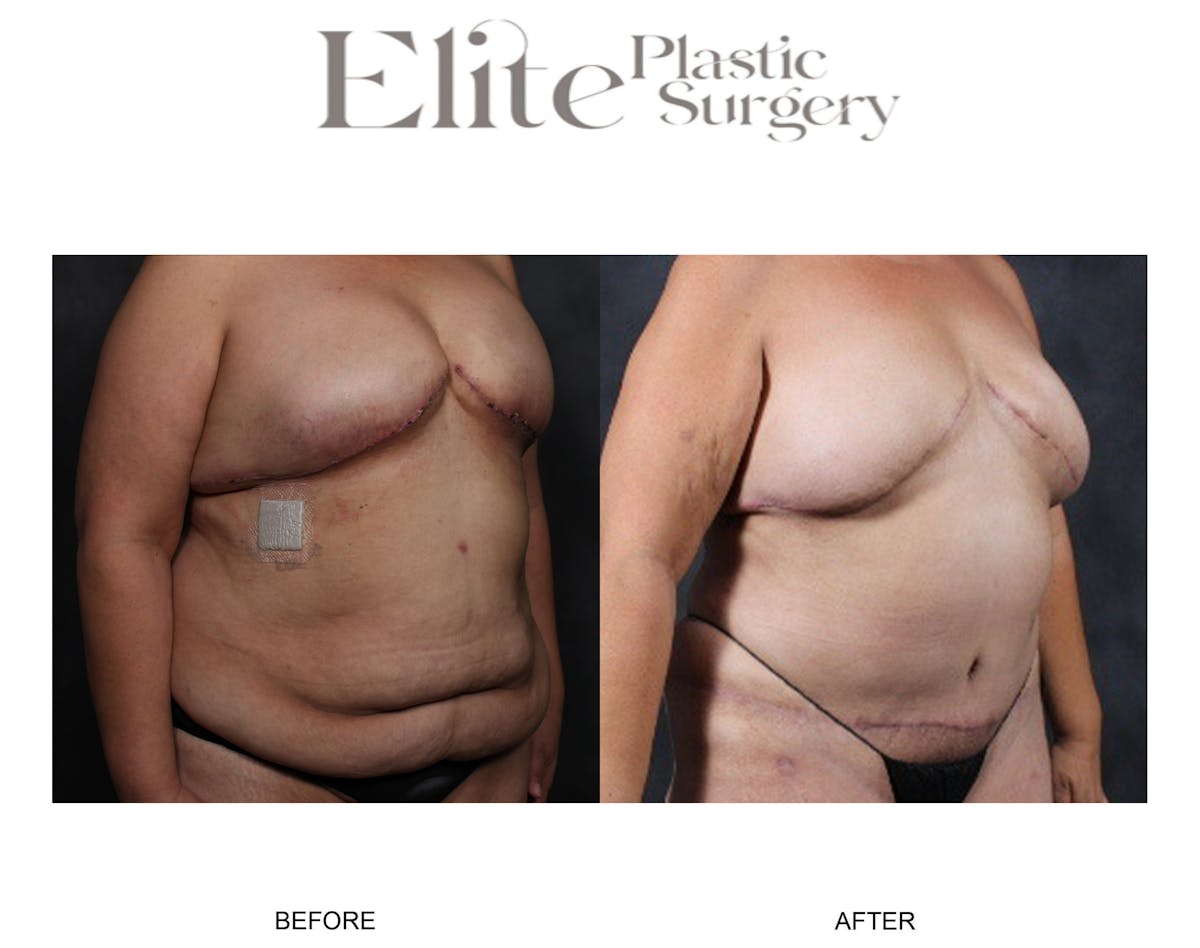 DIEP Breast Reconstruction Before & After Gallery - Patient 348134 - Image 2