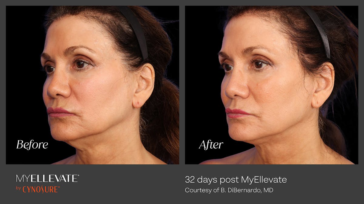 MyEllevate Before & After Gallery - Patient 218657 - Image 1