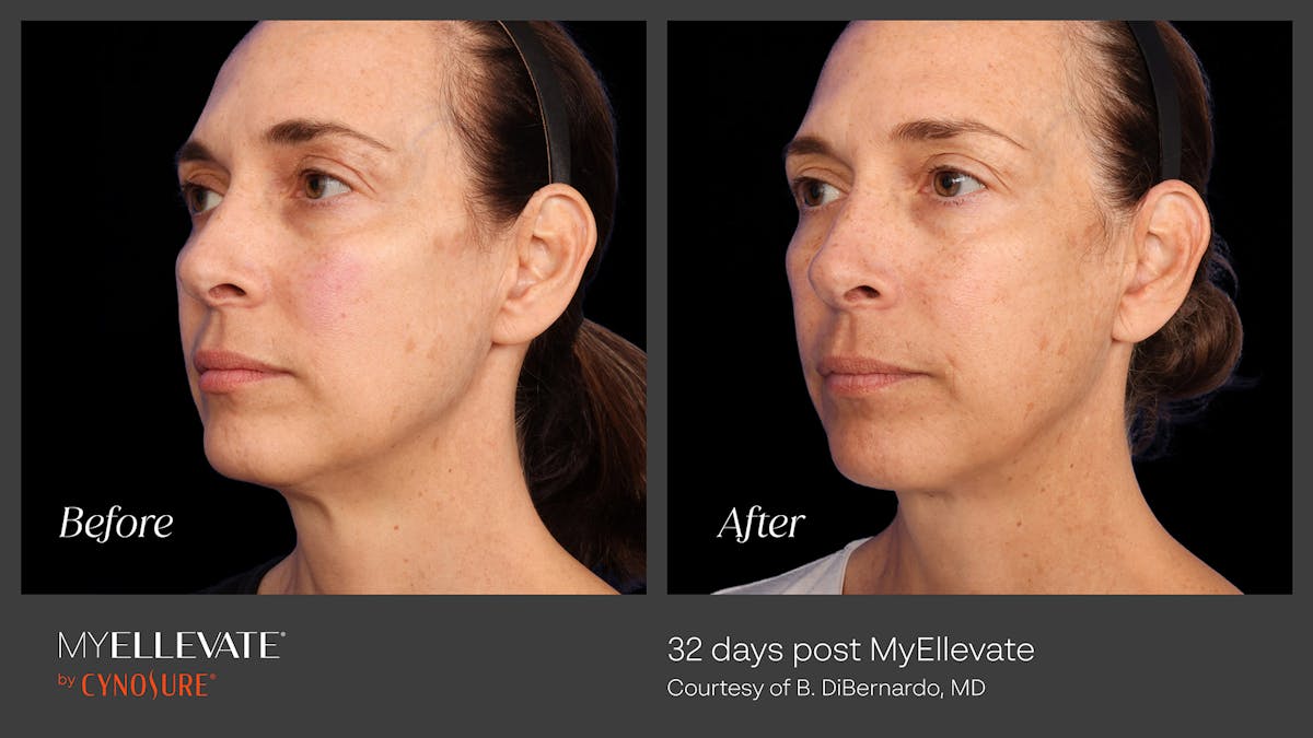 MyEllevate Before & After Gallery - Patient 936119 - Image 1