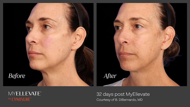 MyEllevate Before & After Gallery - Patient 936119 - Image 1