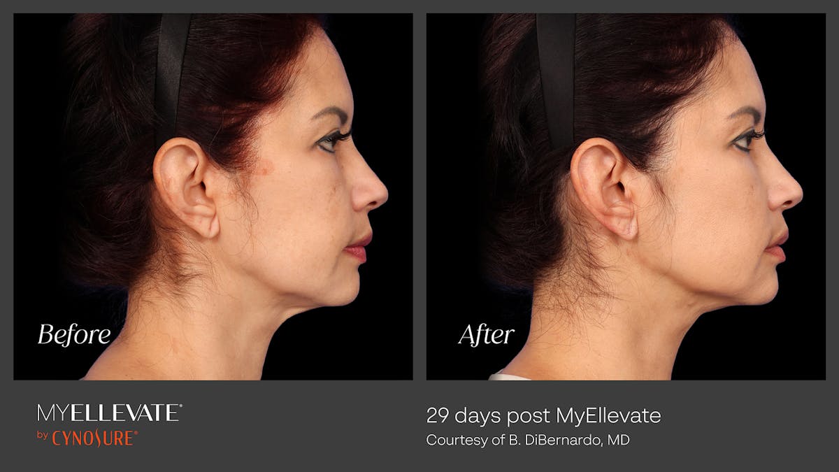 MyEllevate Before & After Gallery - Patient 371455 - Image 1