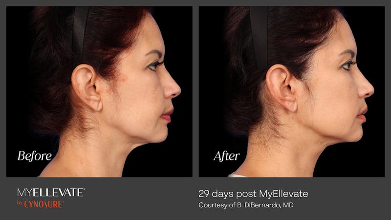 MyEllevate Before & After Gallery - Patient 371455 - Image 1