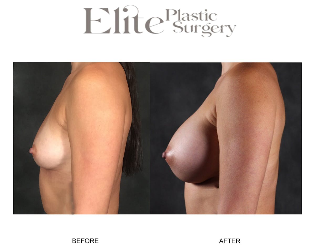 Breast Augmentation Before & After Gallery - Patient 335938 - Image 3