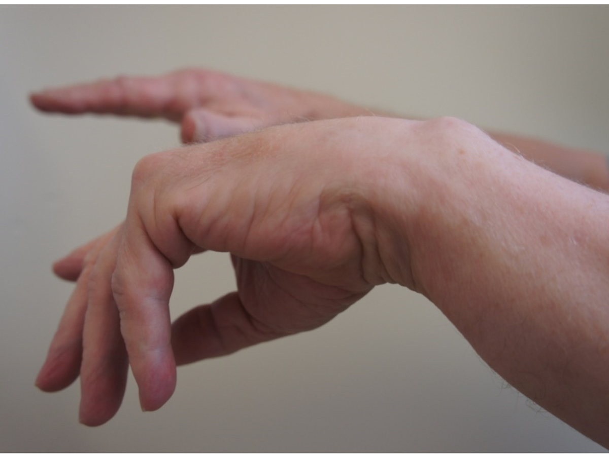 Drooping Hand Nerve Conditions