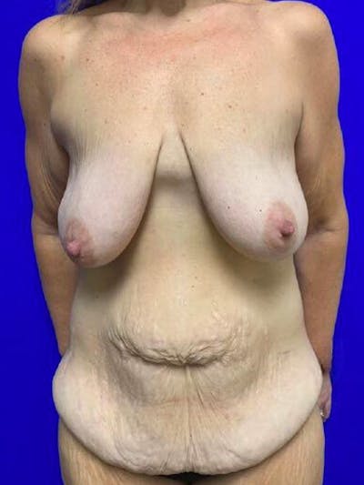 Tummy Tuck Before & After Gallery - Patient 262829 - Image 1