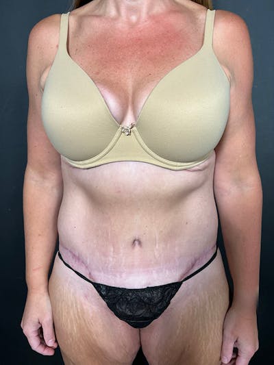 Tummy Tuck Before & After Gallery - Patient 262829 - Image 2