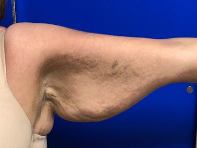 Arm Lift Before & After Gallery - Patient 256451 - Image 1