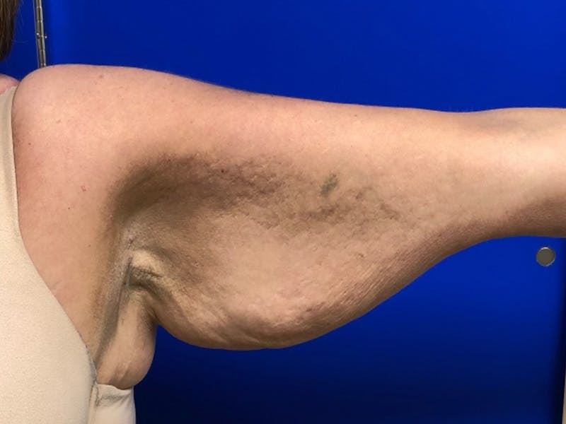 Arm Lift Before & After Gallery - Patient 256451 - Image 1