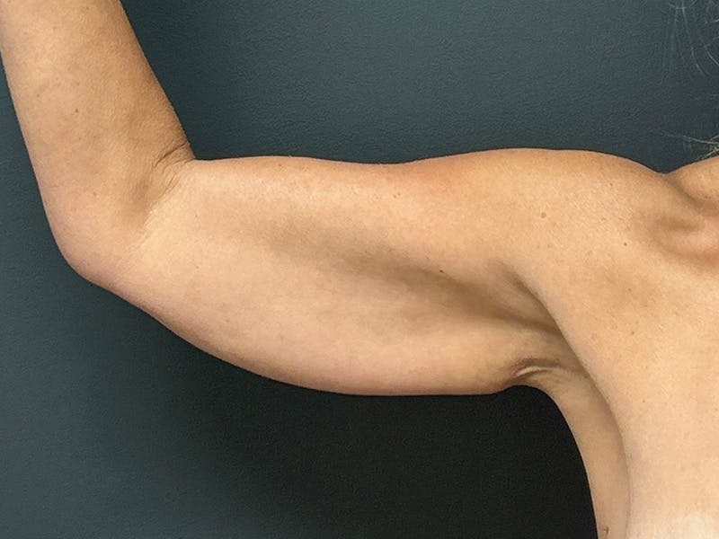 Arm Lift Before & After Gallery - Patient 460783 - Image 3