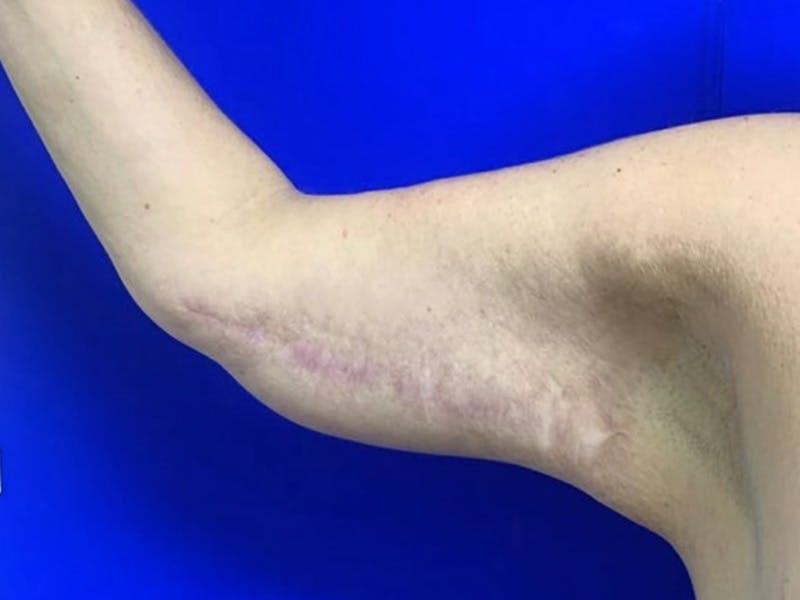 Arm Lift Before & After Gallery - Patient 256451 - Image 8