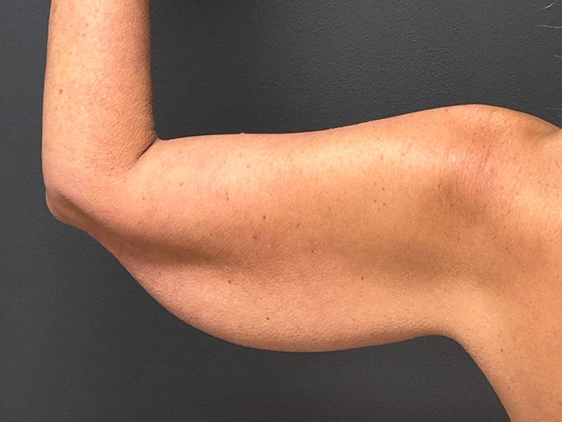 Arm Lift Before & After Gallery - Patient 126876 - Image 5