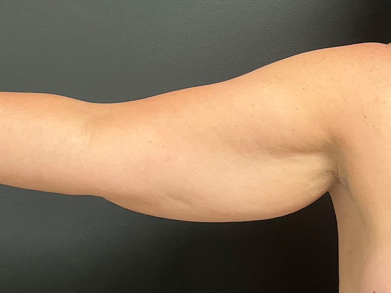 Arm Lift Before & After Gallery - Patient 460783 - Image 5