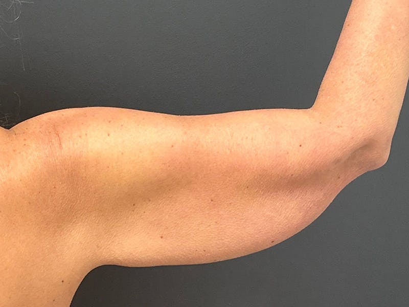Arm Lift Before & After Gallery - Patient 126876 - Image 3