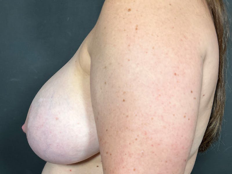 Breast Fat Grafting Before & After Gallery - Patient 125861 - Image 9