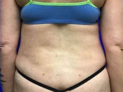 Back Before & After Gallery - Patient 407699 - Image 2