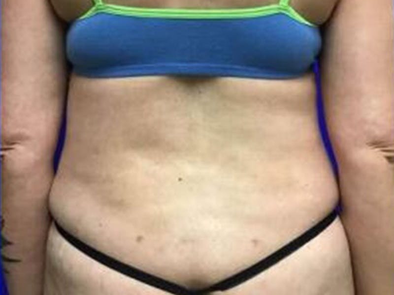 Back Before & After Gallery - Patient 407699 - Image 2