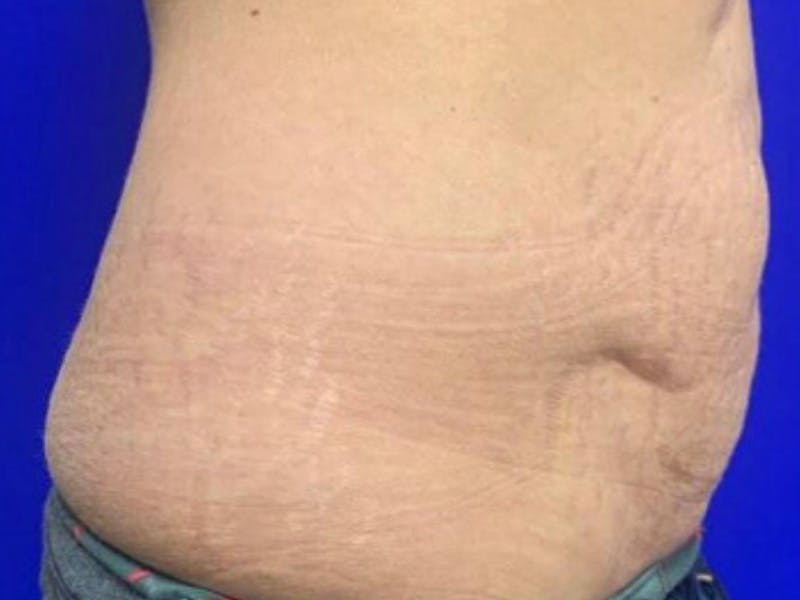 Mini Tummy Tuck Before & After Gallery - Patient 284453 - Image 5