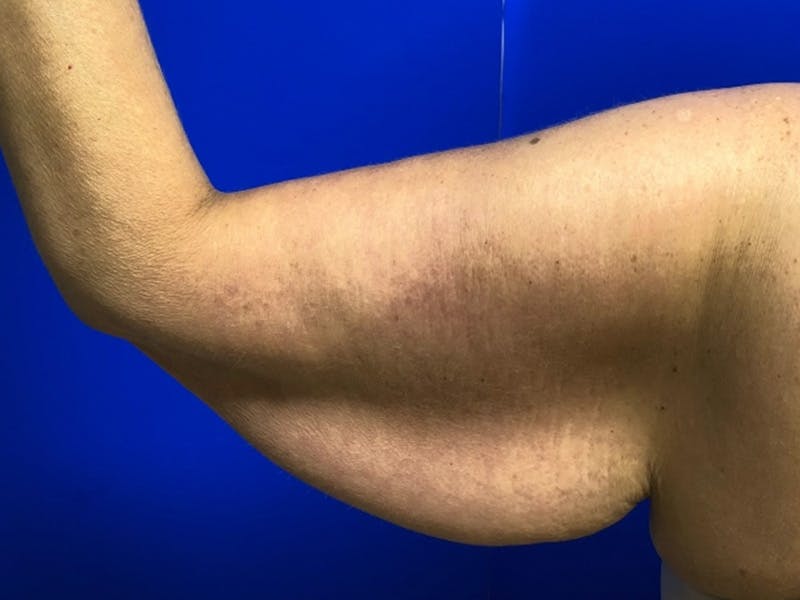 Arm Lift Before & After Gallery - Patient 256451 - Image 5
