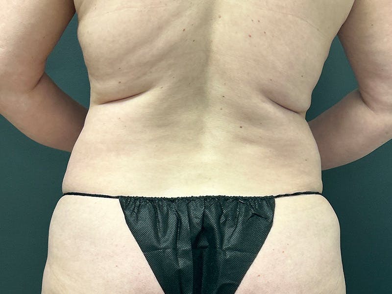 Back Before & After Gallery - Patient 302715 - Image 1