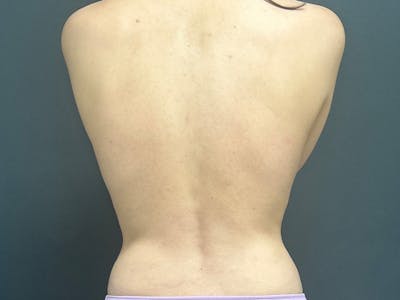 Back Before & After Gallery - Patient 166545 - Image 2