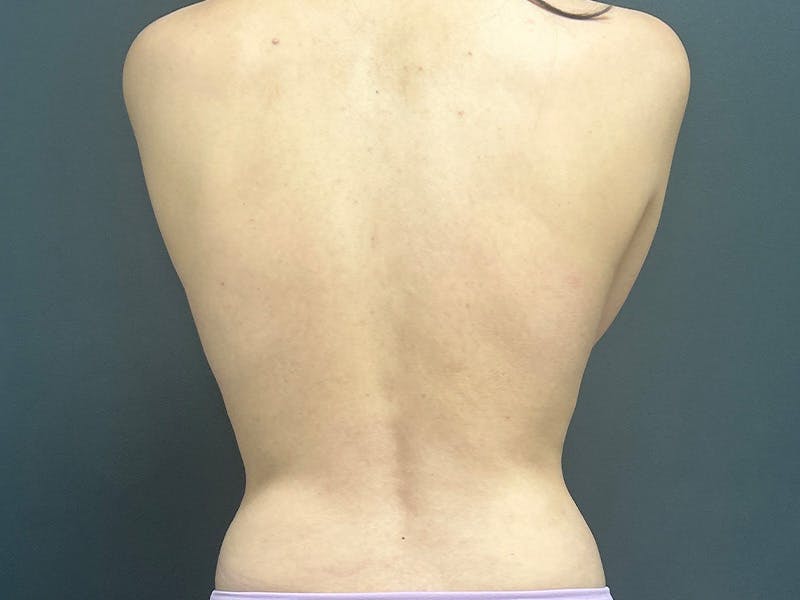 Back Before & After Gallery - Patient 166545 - Image 2