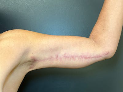 Arm Lift Before & After Gallery - Patient 126876 - Image 2