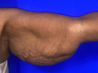 Arm Lift Before & After Gallery - Patient 122659 - Image 1