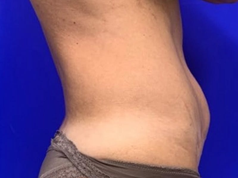 Mini Tummy Tuck Before & After Gallery - Patient 309547 - Image 5