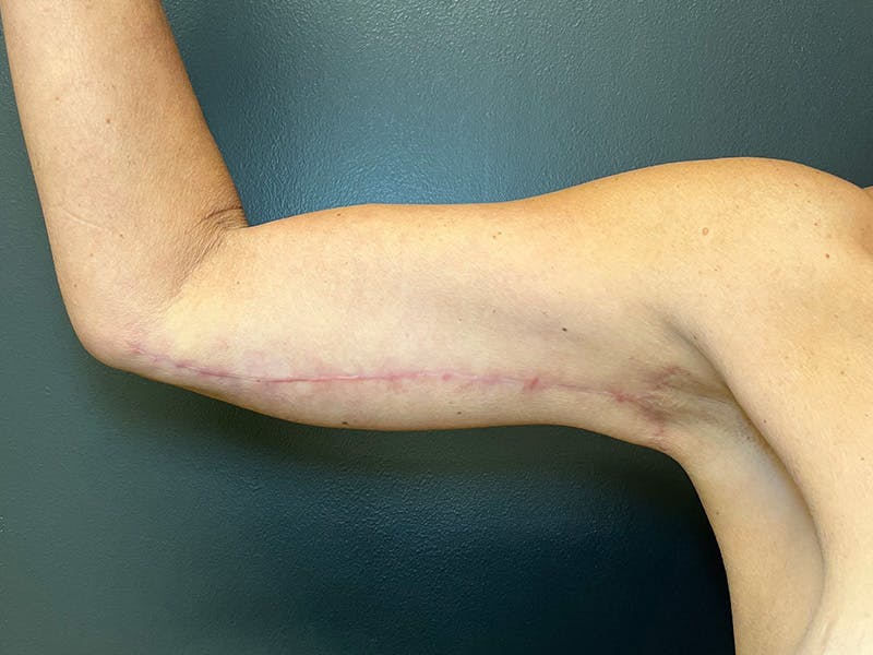Arm Lift Before & After Gallery - Patient 126876 - Image 8