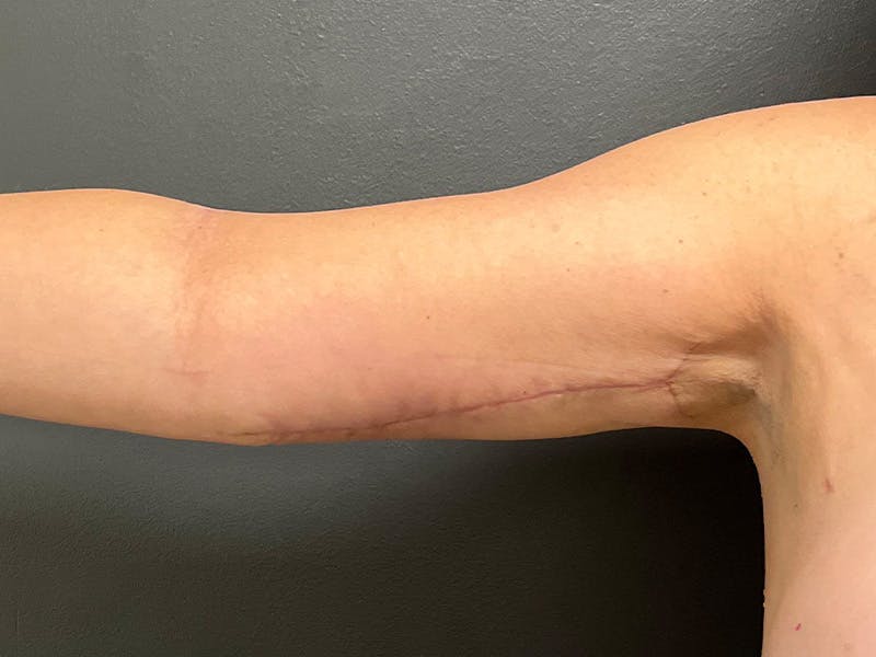 Arm Lift Before & After Gallery - Patient 460783 - Image 6