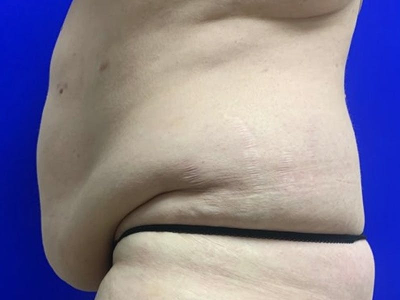 Tummy Tuck Before & After Gallery - Patient 548883 - Image 5