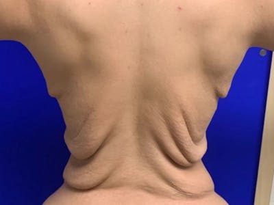 Back Lift Before & After Gallery - Patient 317434 - Image 1