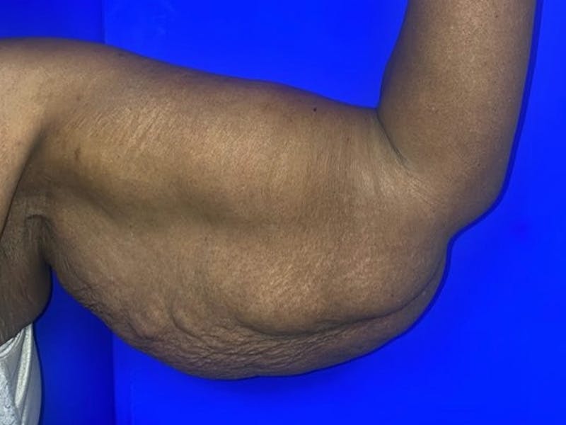 Arm Lift Before & After Gallery - Patient 122659 - Image 3