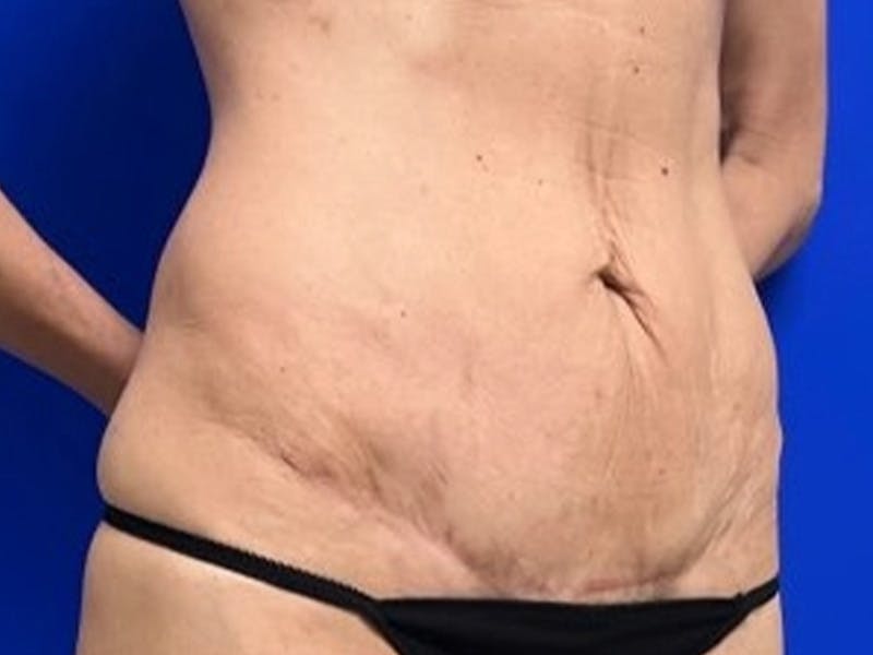 Mini Tummy Tuck Before & After Gallery - Patient 309547 - Image 4