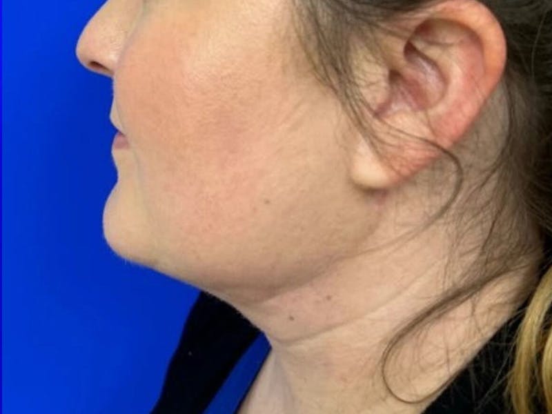Submental Before & After Gallery - Patient 120511 - Image 10