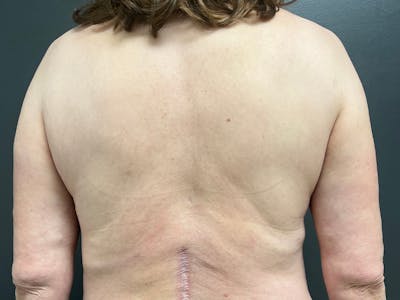 Back Lift Before & After Gallery - Patient 368284 - Image 1