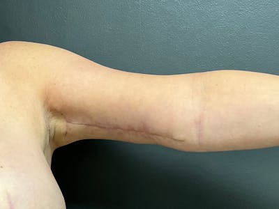 Arm Lift Before & After Gallery - Patient 460783 - Image 2