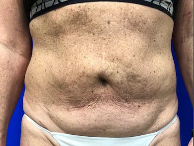 Tummy Tuck Before & After Gallery - Patient 334681 - Image 1