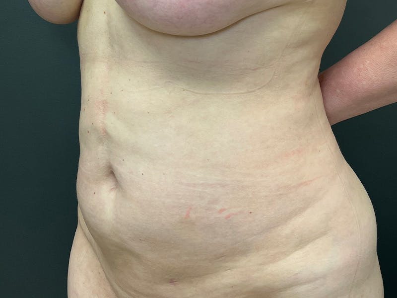 Abdomen Before & After Gallery - Patient 272999 - Image 4
