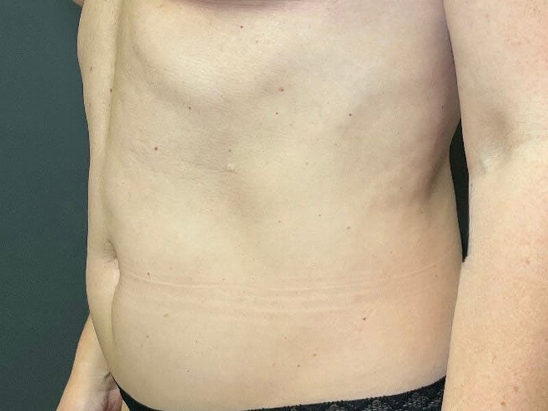 Mini Tummy Tuck Before & After Gallery - Patient 418282 - Image 8