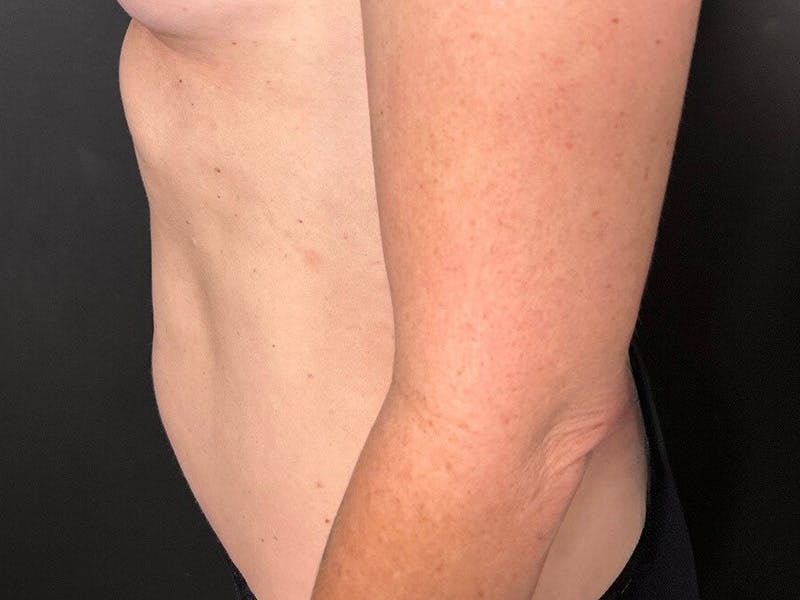 Mini Tummy Tuck Before & After Gallery - Patient 418282 - Image 9