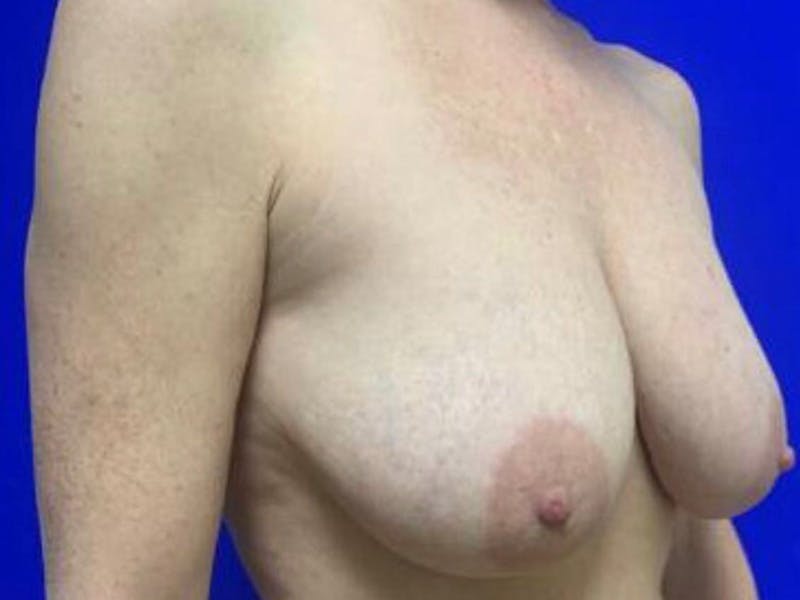 Mastopexy (Breast Lift) Before & After Gallery - Patient 402414 - Image 3